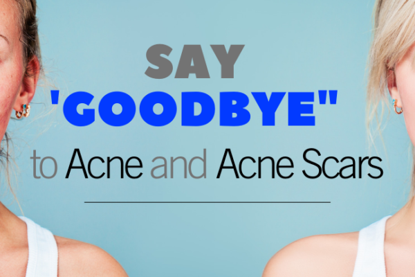 ACNE AND ACNE SCARS