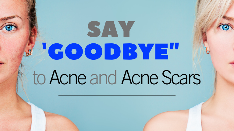 ACNE AND ACNE SCARS