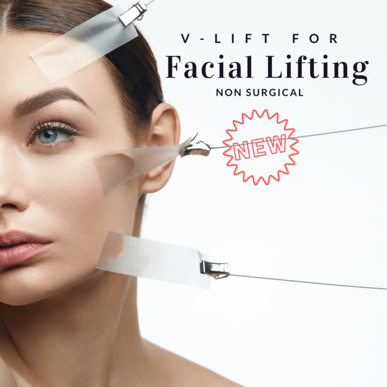 VLIFT Treatment that lifts sunken cheeks and droopy jowls! Lesprit Medical Clinic
