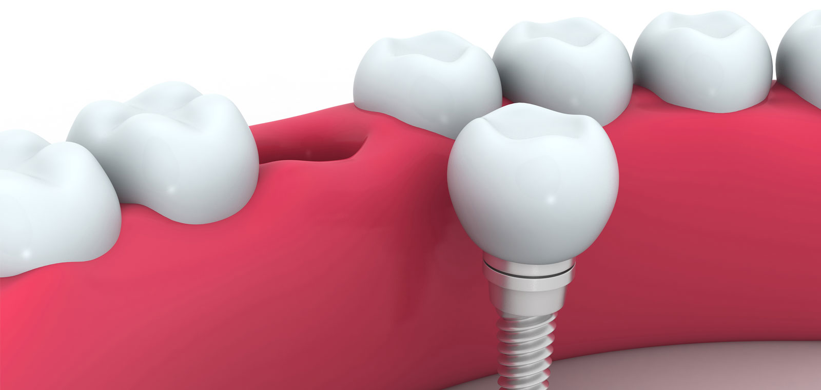 Dental Implants